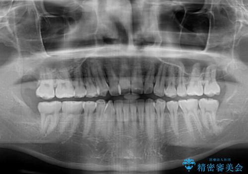 八重歯と前歯のクロスバイト ワイヤー装置で短期間矯正の治療前