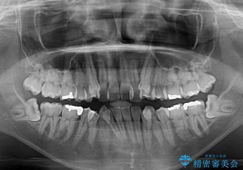 気になる八重歯を目立たない装置で改善　ハーフリンガル矯正の治療前