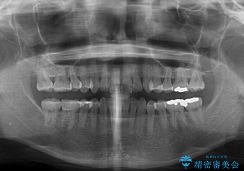 矯正治療の後戻り インビザライン・ライトによる矯正治療の治療前