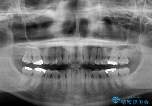 海外で仕事をしながらインビザラインで矯正治療の治療前