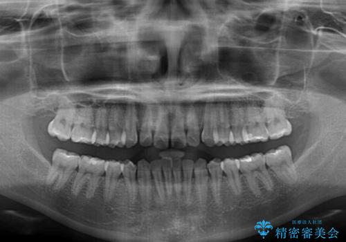 【モニター】すきっ歯をインビザラインで解消の治療前