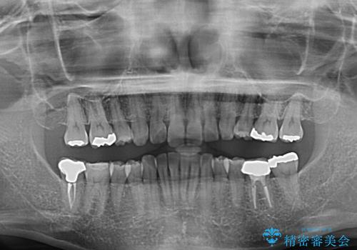 抜歯矯正の後戻りでできたスペース　インビザライン矯正とセラミック治療の治療前