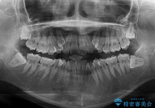 著しい八重歯が気になる インビザラインでの矯正治療の治療前