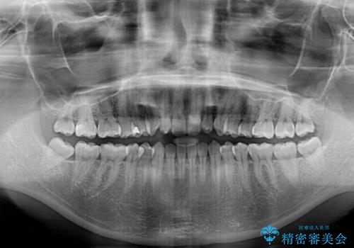 インビザラインを用いた上顎の部分矯正の治療前
