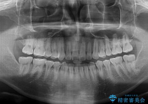 八重歯と前歯のクロスバイト ワイヤー装置で短期間矯正の治療後