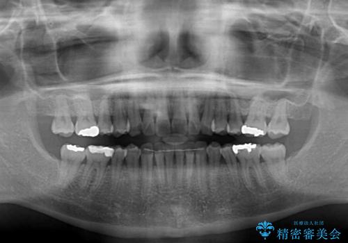 海外で仕事をしながらインビザラインで矯正治療の治療後