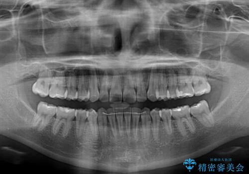 【モニター】すきっ歯をインビザラインで解消の治療後