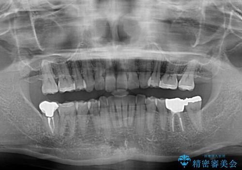 抜歯矯正の後戻りでできたスペース インビザライン矯正とセラミック治療の治療後