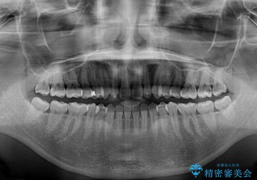 インビザラインを用いた上顎の部分矯正の治療後