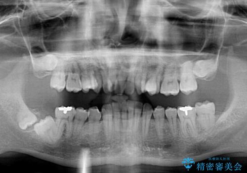 前歯が折れたついでに歯並びも改善 矯正治療と前歯のセラミック治療の治療前
