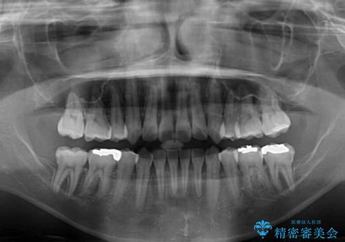 気になる八重歯を目立たない装置で改善　ハーフリンガル矯正の治療後
