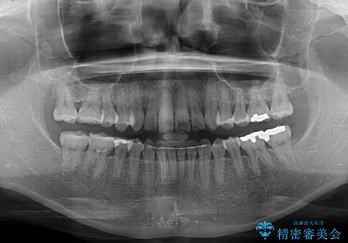 矯正治療の後戻り インビザライン・ライトによる矯正治療の治療後