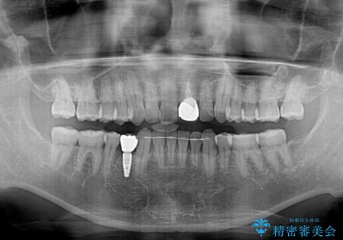欠損歯列の矯正治療とインプラント治療の治療後