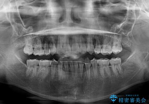 著しい八重歯が気になる インビザラインでの矯正治療の治療後