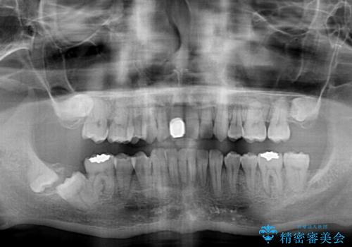 前歯が折れたついでに歯並びも改善 矯正治療と前歯のセラミック治療の治療後