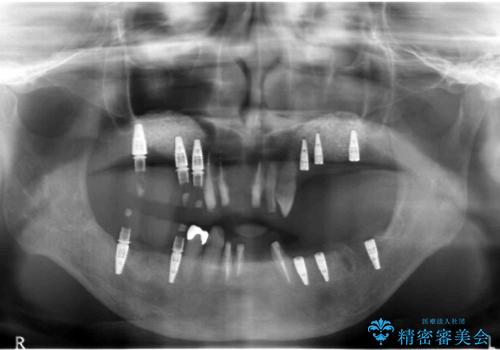 [ 歯周病による多数歯の欠損 ]   全顎的インプラント・歯周病治療の治療中
