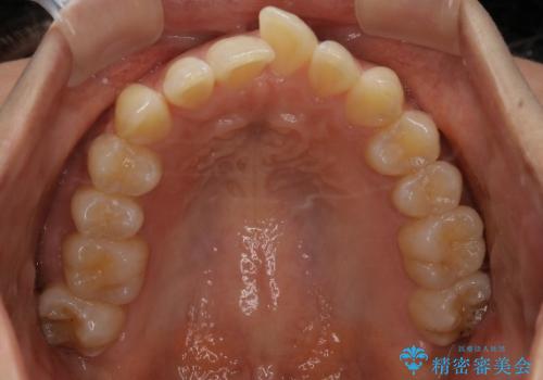 飛び出た前歯をインビザラインで綺麗に引っ込めた症例