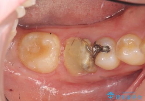 放置した虫歯　インプラントによる機能回復の治療前