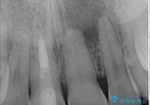 【ホワイトニング】右上前歯の歯茎の辺りが暗いのが気になる。の治療後
