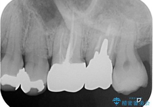 【セラミックインレー】再治療を防ぐ虫歯治療の治療前