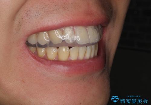 筋トレ時の歯を守るマウスガードの治療後