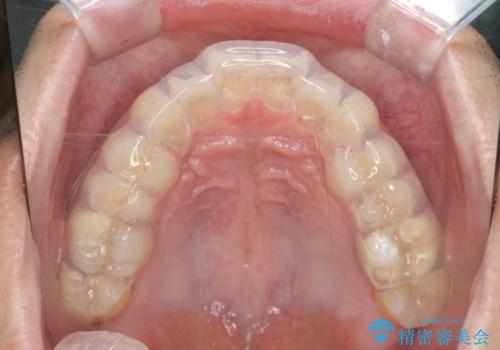 筋トレ時の歯を守るスポーツ用マウスガードの治療中