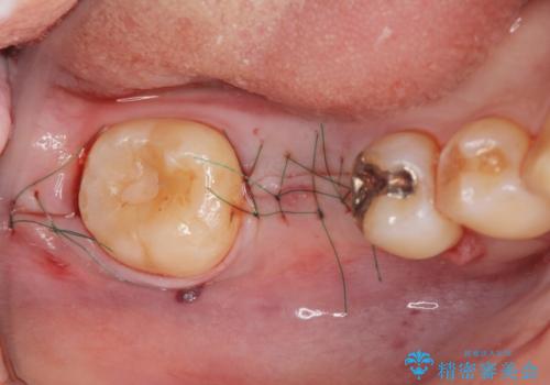 放置した虫歯 インプラントによる機能回復の治療中