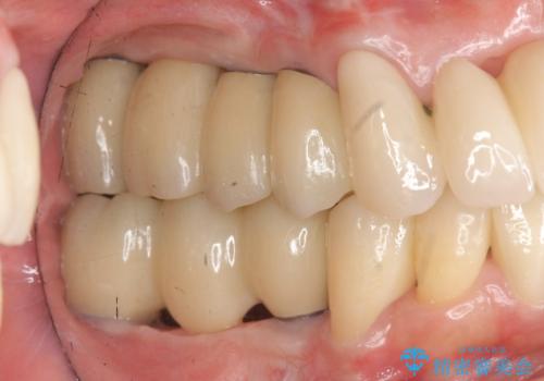 [ 歯周病による多数歯の欠損 ]   全顎的インプラント・歯周病治療の治療後