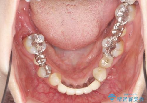 [ 歯周病による多数歯の欠損 ]   全顎的インプラント・歯周病治療の治療前