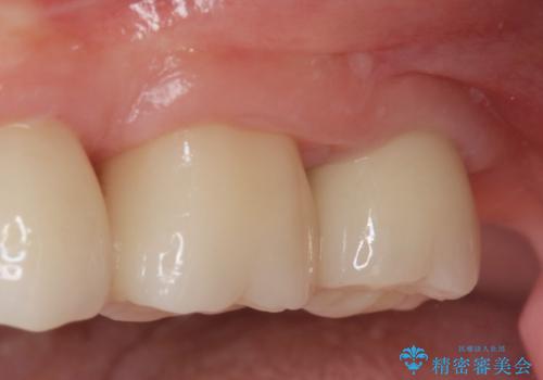 [ 2次カリエス ]クラウンのグラつき クラウン下の虫歯再発の治療後