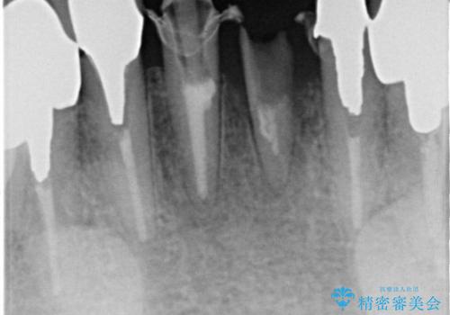 前歯が一本取れた オールセラミックブリッジによる補綴治療の治療前