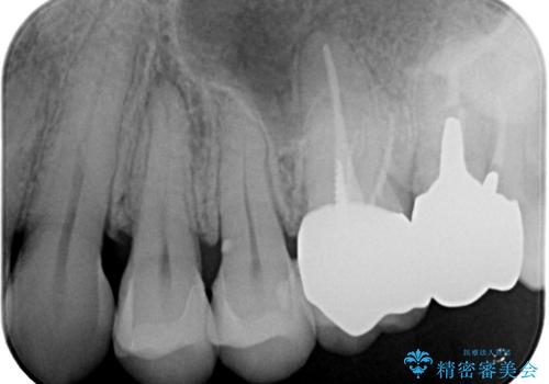 【セラミックインレー】再治療を防ぐ虫歯治療の治療後
