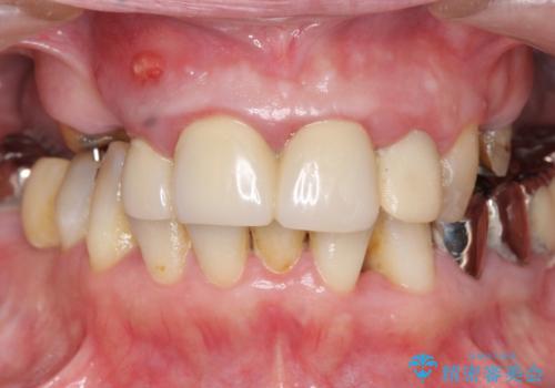[ 前歯のオールセラミックブリッジ ]  前歯の腫れ・痛み・ニオイ・出血が気になるの症例 治療前