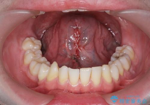 [ 舌小帯形成術 ]舌が短い 小手術での改善の治療中