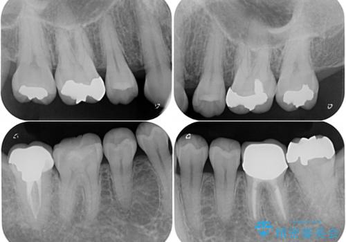 抜歯矯正の後戻りでできたスペース インビザライン矯正とセラミック治療の治療前