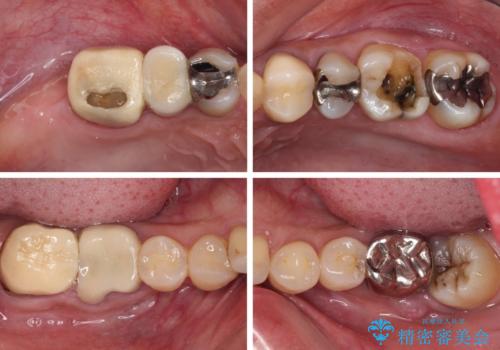 治療中放置してしまった奥歯 セラミック治療の治療前