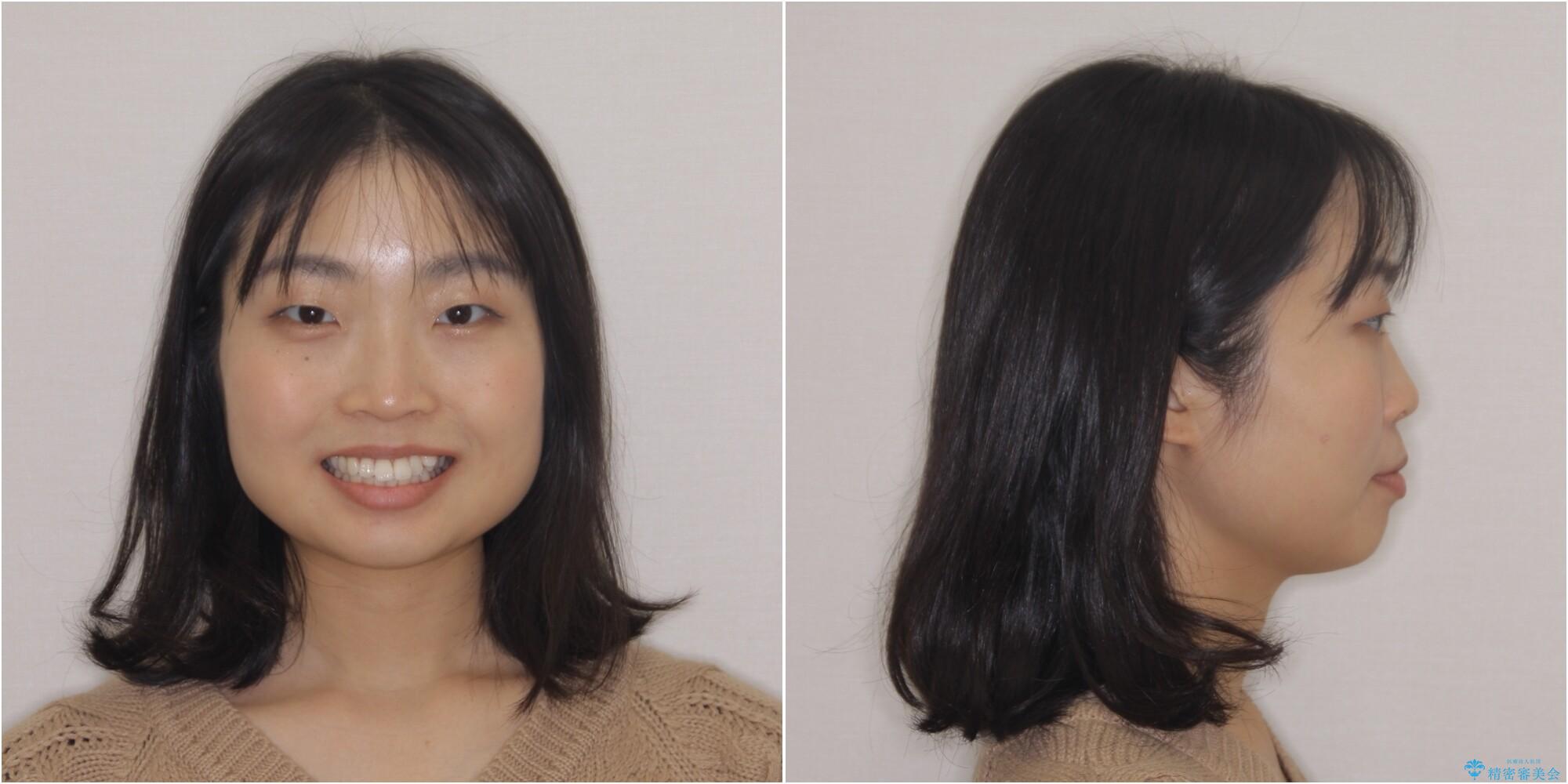 【モニター】気になる八重歯を素早く改善 ワイヤー装置での抜歯矯正の治療前(顔貌)