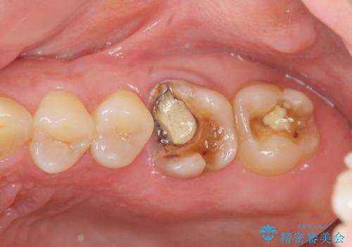 放置した虫歯　精密な治療の希望の症例 治療前