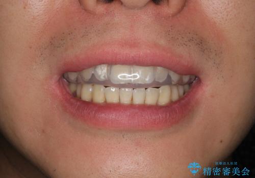 筋トレ時の歯を守るスポーツ用マウスガードの治療前