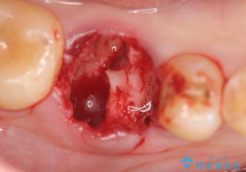 放置した虫歯 インプラントによる機能回復の治療前