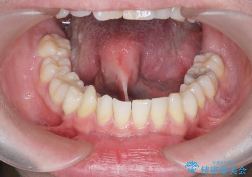 [ 舌小帯形成術 ]舌が短い 小手術での改善の治療前