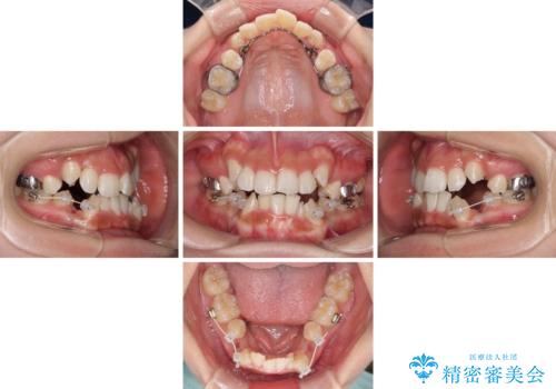 著しい八重歯が気になる インビザラインでの矯正治療の治療中
