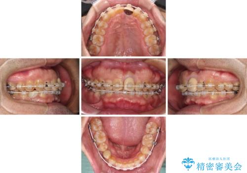 欠損歯列の矯正治療とインプラント治療の治療中