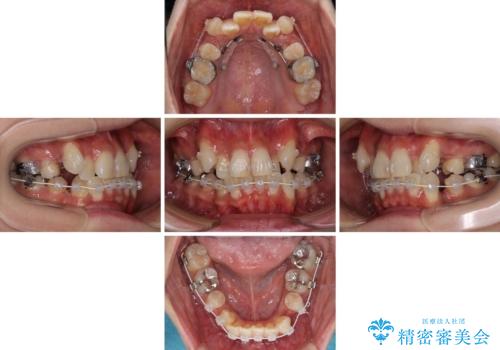 気になる八重歯を目立たない装置で改善　ハーフリンガル矯正の治療中