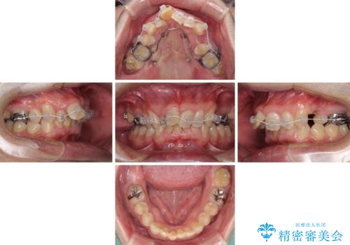 前歯が折れたついでに歯並びも改善 矯正治療と前歯のセラミック治療の治療中