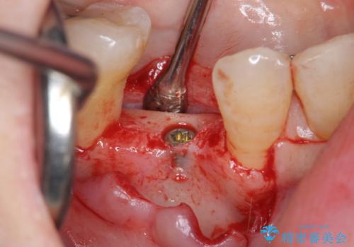 [ 臼歯部インプラント治療 ]   抜けた歯を治療したいの治療前