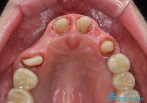 [ 前歯のオールセラミックブリッジ ]  前歯の腫れ・痛み・ニオイ・出血が気になるの治療中