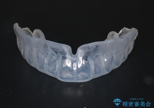 筋トレ時の歯を守るスポーツ用マウスガードの治療前