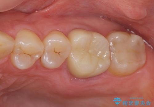 放置した虫歯　精密な治療の希望の症例 治療後
