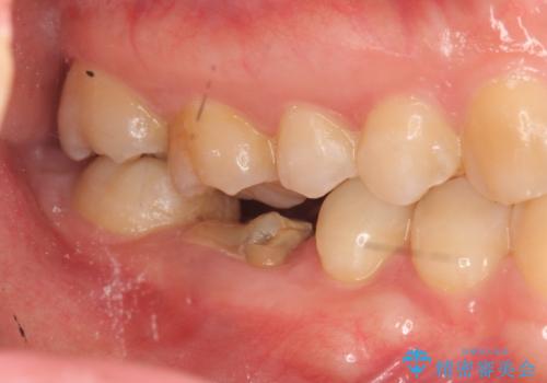 放置した虫歯 インプラントによる機能回復の治療前